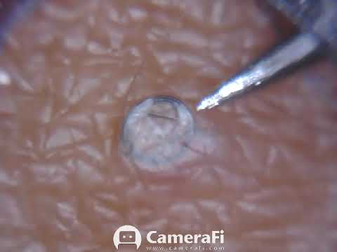 Repeat Satisfying Ingrown Hair Removal 22 By Ms Microscope