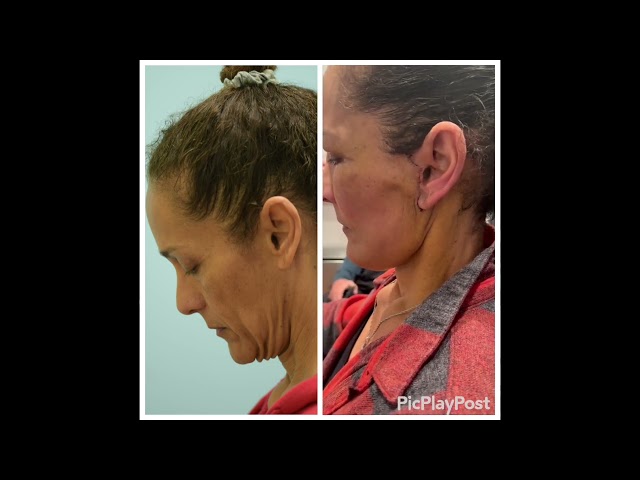 Dallas Deep Neck Lift, Fat Grafting and Blepharoplasty One Week Post Before & After