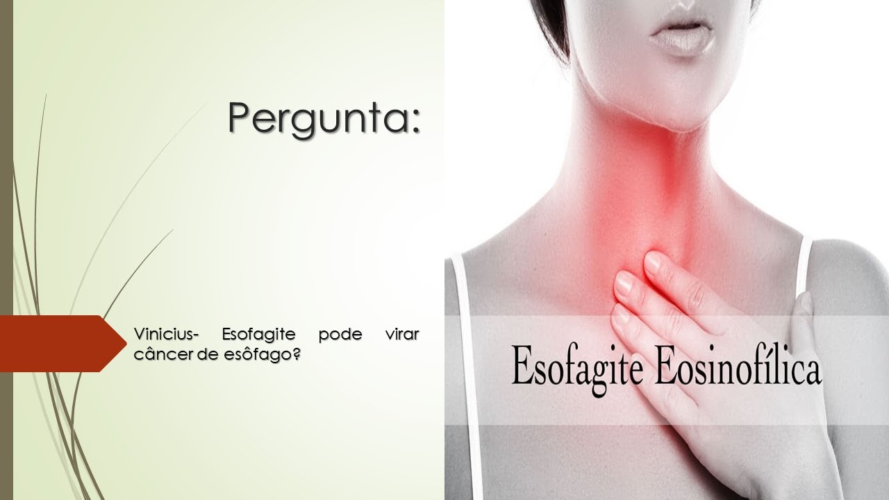 Esofagite pode virar câncer de esôfago? - YouTube