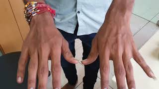 Hand Tremors in Thyrotoxicosis. #thyroid #tremors #Graves