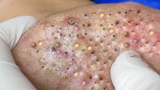 Relax Every Day With Treatment Satisfying blackhead relaxing acne, pimple, cyst by FISHING VIDEO 148 views 1 year ago 4 minutes, 56 seconds