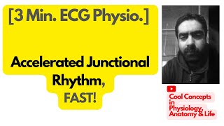 How to Spot Accelerated Junctional Rhythm on ECG, FAST?  #ECGInterpretation #EKGTutorial #LearnECG