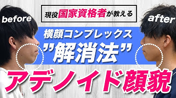 アデノイド顔貌 Youtube