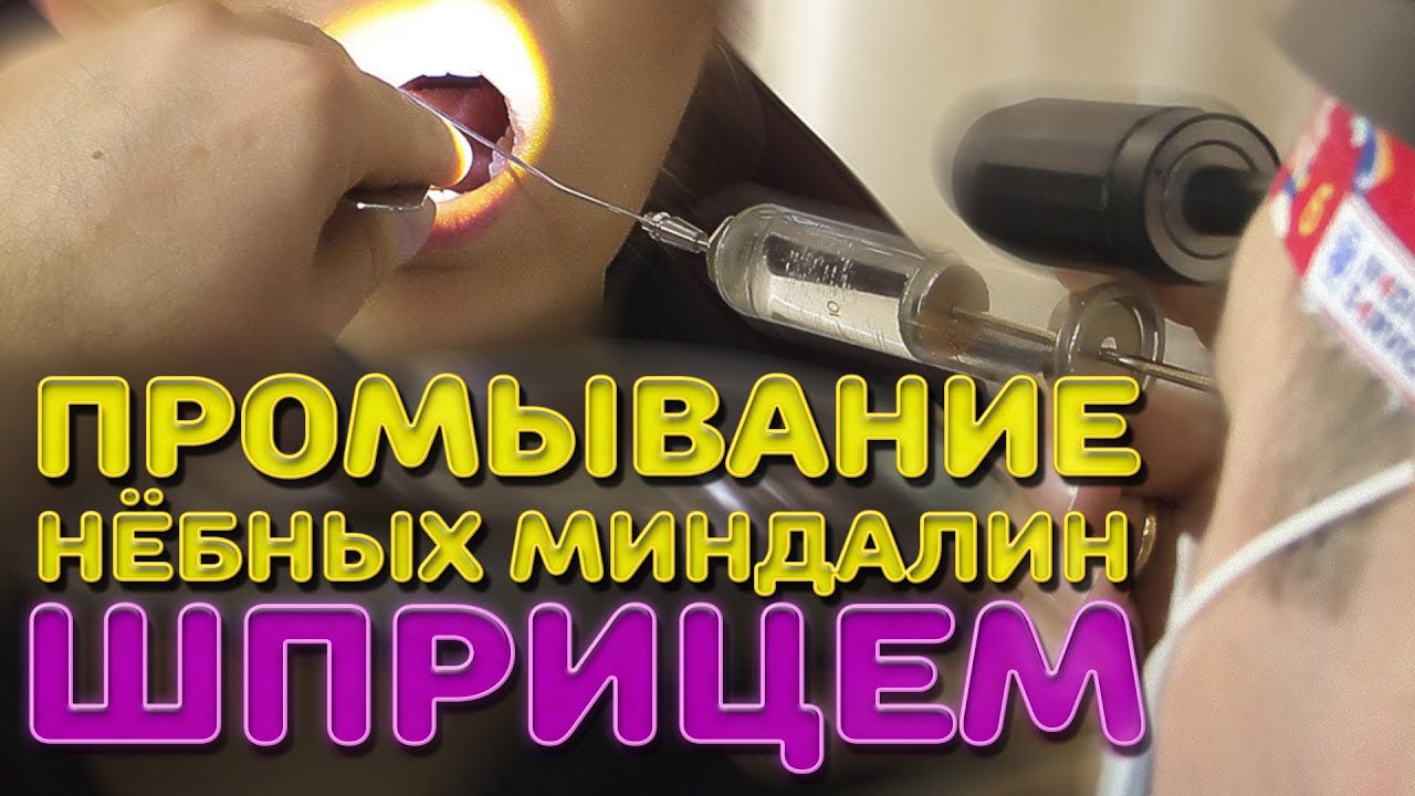 Промывание нёбных миндалин шприцем | Лечим правильно с Владимиром Зайцевым