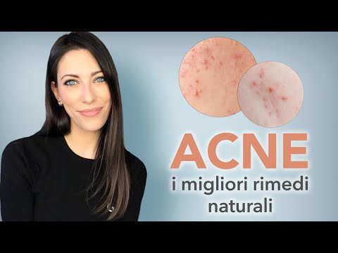Video: Il solarium può aiutare l'acne?