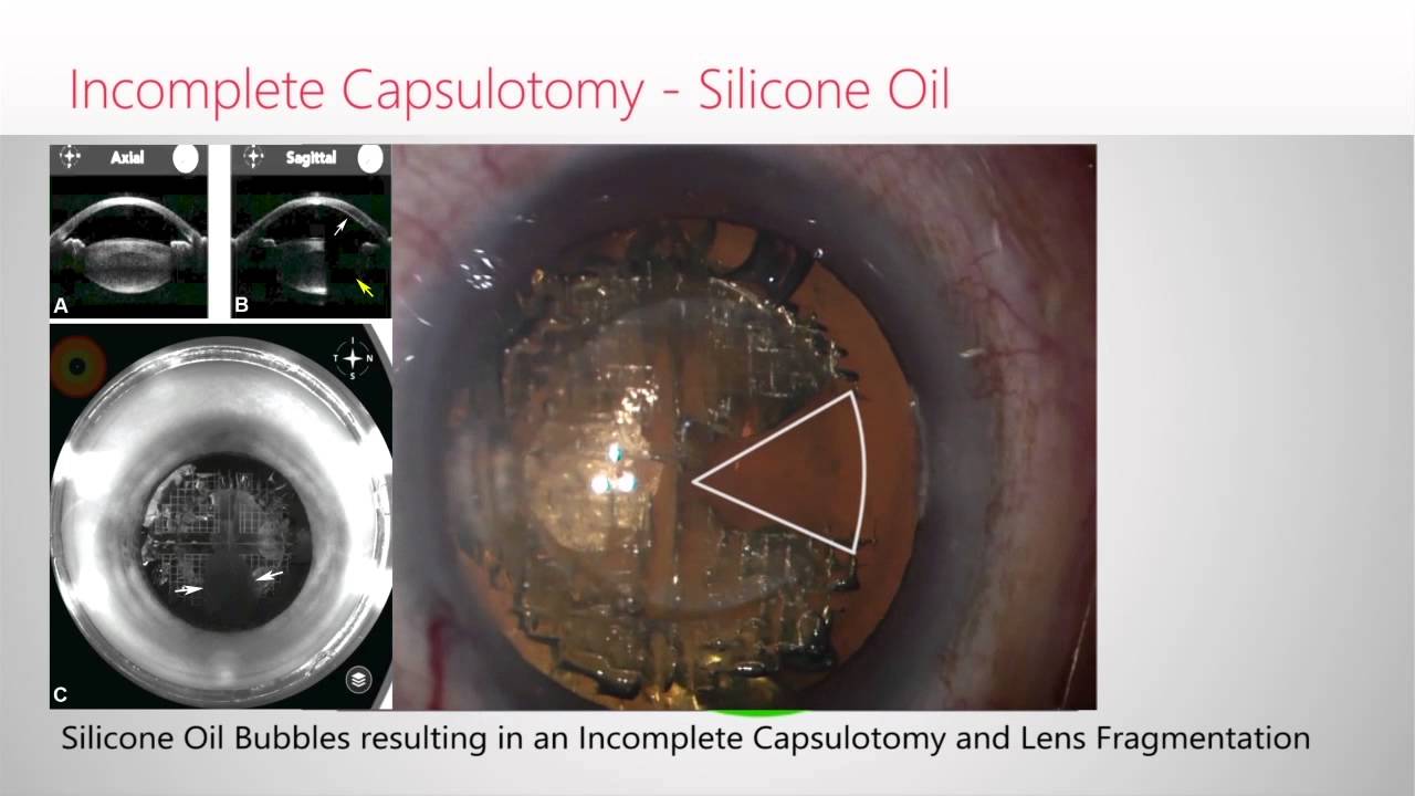 Intraop Complications of Femtosecond Laser Cataract Surgery YouTube