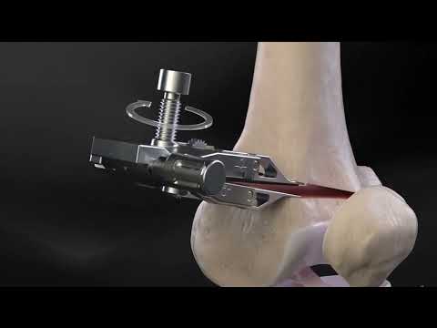 Distal Femoral Osteotomi