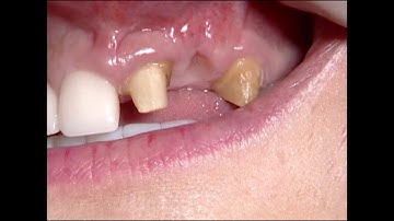 Demo C2-1 Soft Tissue Ridge Augmentation with Papilla Elevation