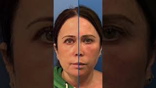 What Is A Blepharoplasty?
