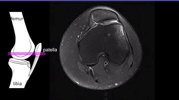 Patellar measurements