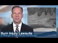Atlanta burn injuries due to accident or otherwise, involve specific legal issues because these injuries can often take time to develop. Scarring may not be evident right away and victims need protection to ensure their rights are preserved while they get medical help. Once the extent of the injuries is known, the case can be resolved. This video explains why legal representation is so important to those injured.