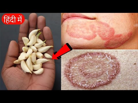 3 दिन - पुराने से पुराने दाद, खाज, खुजली को दूर करने का सबसे सफल उपाय - Ringworm Treatment Naturally