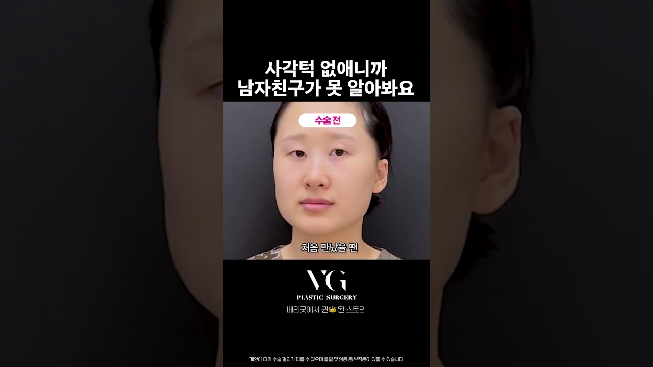 [貝利古德整形外科診所] 方下巴手術後，蛻變成女王的成長記 #面部輪廓 #輪廓手術 #輪廓三件套