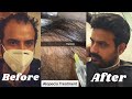 Hair loss treatment of my husband | PRP Microneedling | hair regrowth