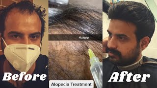 Hair loss treatment of my husband | PRP Microneedling | hair regrowth