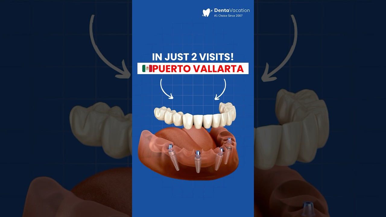 All on 4 Implants in Puerto Vallarta, Mexico in Only 2 Visits!