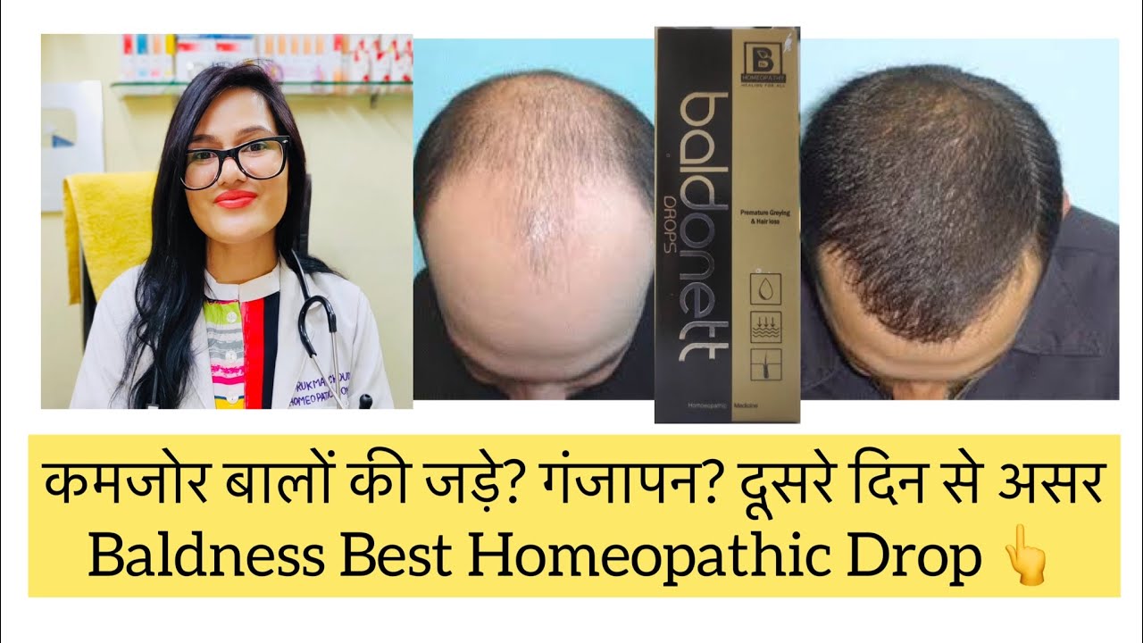 बालों की कमज़ोर जड़े? Weak Hair follicles Homeopathic Medicine