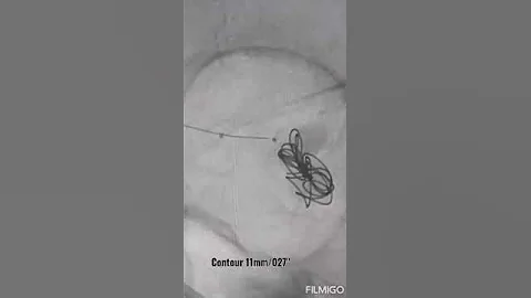 65y/F with brain hemorrhage (SAH) had wide neck complex MCA aneurysm.