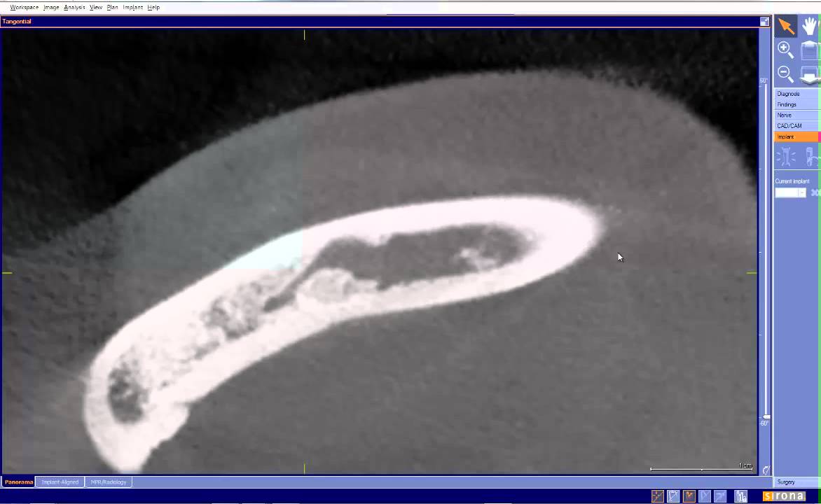 anterior loop mental nerve cullen - YouTube