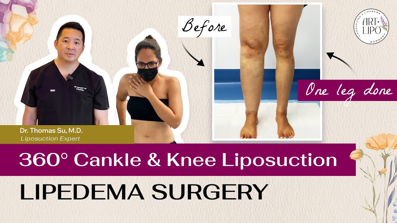 LIPEDEMA 360 CANKLE KNEE LIPOSUCTION Artlipo Expert Dr Thomas lipedema-360-cankle-knee-liposuction-artlipo-expert-dr-thomas