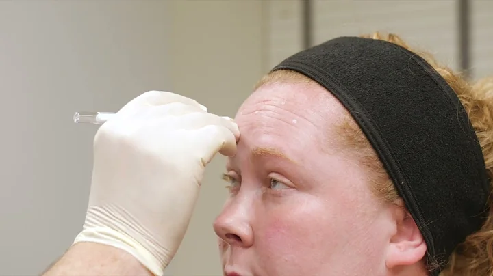 Correction of forehead lines with toxin
