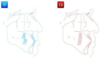 Solving anterior X-bite with Invisalign｜【Chris Chang Ortho】CC643
