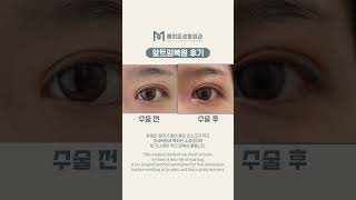 눈이 이렇게 시원해 보인다? !앞트임복원 전후 결과