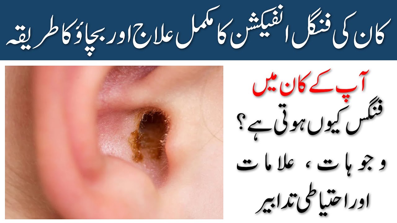 Fungal Ear Infection (Otomycosis) in Urdu | Kaan Mein Fungus Ka Ilaj, Alamat Aur Asbab