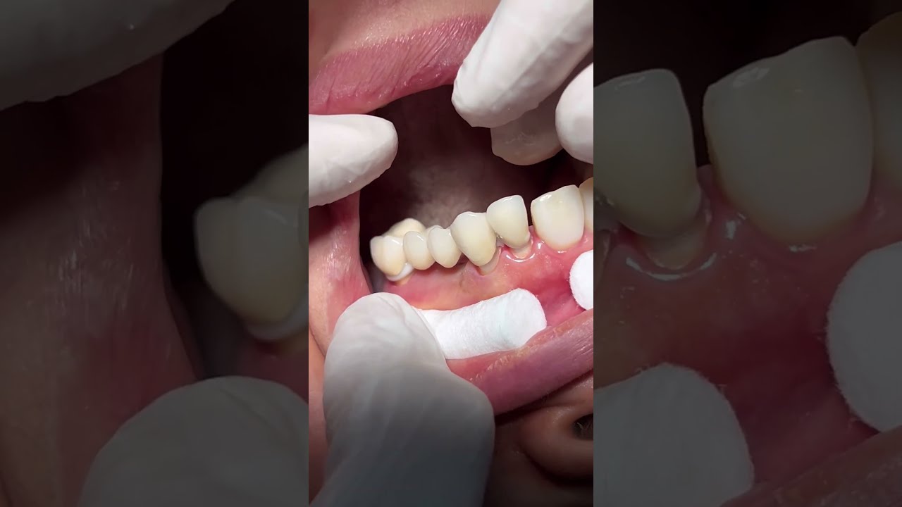 Fixed Bridge Dentist Dental