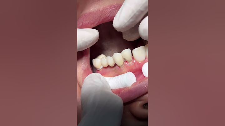 Fixed bridge #dentist #dental