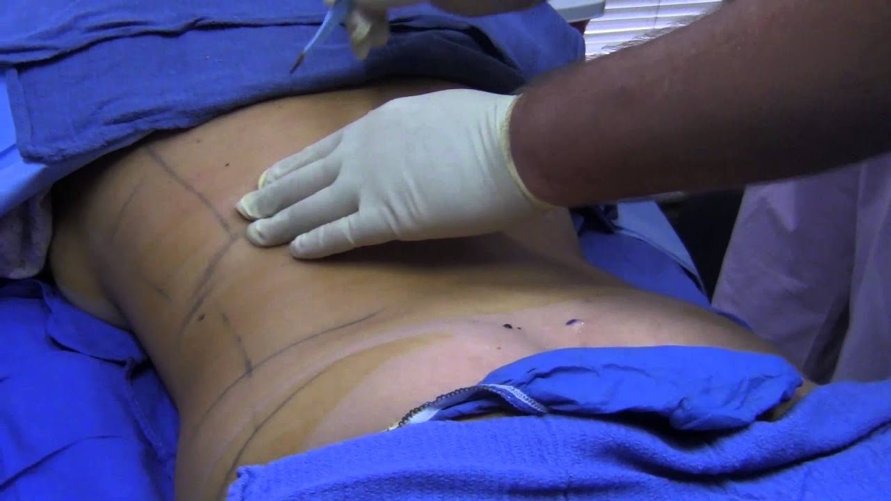 Smart Liposuction - SmartLipo in Northern California - Steven K. Struck, M.D.
