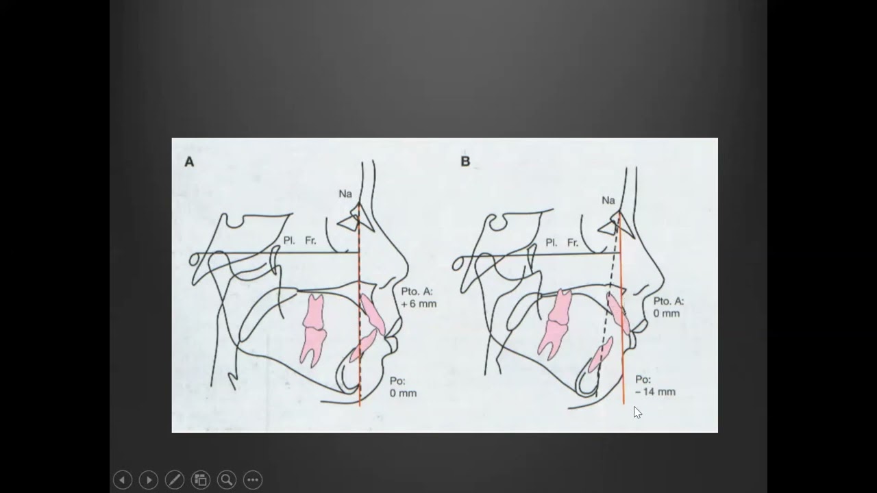 23 Cefalograma Mc Namara y Análisis dentario de Ricketts