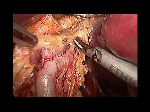 Laparoscopic Extended D2+ Gastrectomy With Liver & Diaphragmal Resection