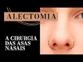 Alectomia: Redução da Asa Nasal na Rinoplastia - Dr. Fábio Maniglia
