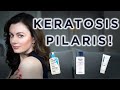 Keratosis Pilaris... The Products That Will Smooth Your Skin | Dr Sam Bunting