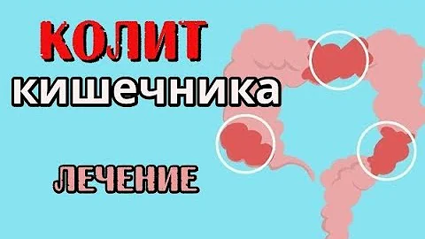 Колит кишечника. Лечение