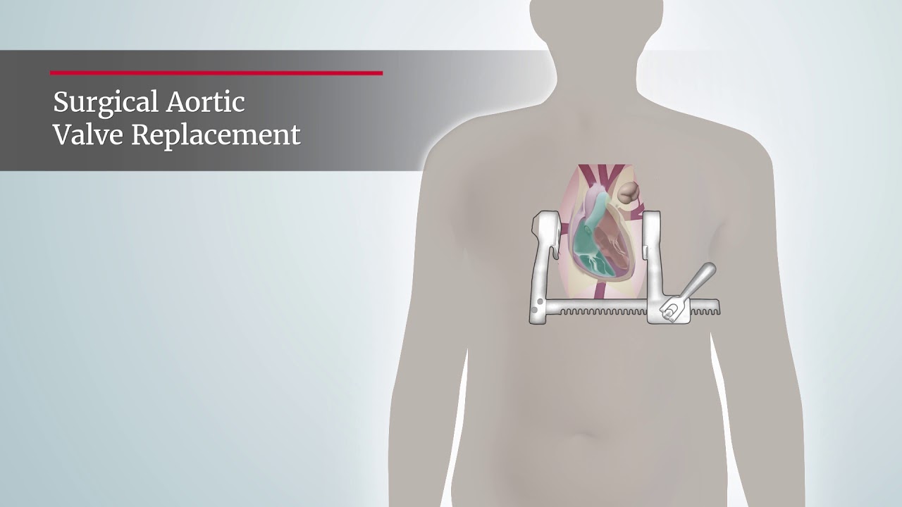 Aortic Stenosis Surgical Aortic Valve Replacement Procedure Youtube
