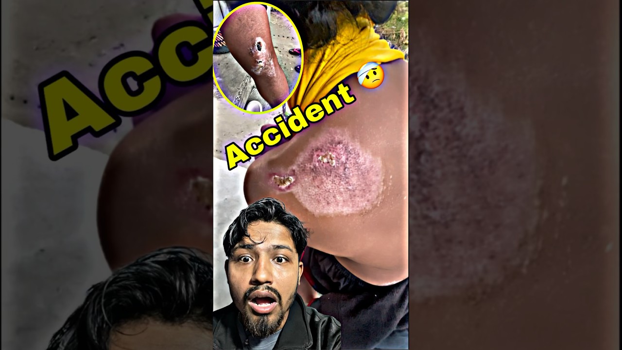 Accident 🤕😳 || mini vlog || 