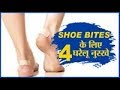 Home Remedies for Shoe Bites | 4 Home Remedies To Prevent A Shoe Bite Instantly | Mission Girl
