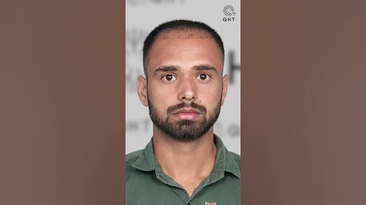 Seven Months Hair Transplant Results | Latest Fue Technique #shorts #viral #hair transplant