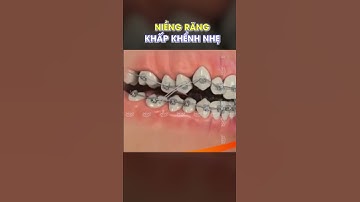 Niềng răng cho trường hợp răng khấp khểnh nhẹ?