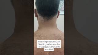 "Unlocking Relief: How Dry Needling and Alternative Therapies Can Transform Your Life!"