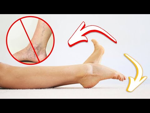 Get rid of varicose veins in 3 minutes with one simple movement!