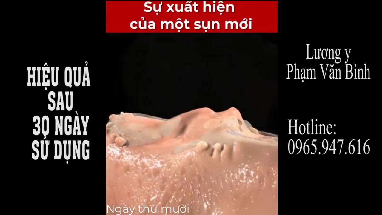 QUÁ TRÌNH PHỤC SAU KHI DÙNG JOINT MAX