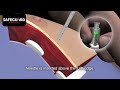 How to safely insert the russell pneumofix from safeguard medical