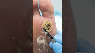 Deep Nail Cavity Cleaning Part-4 #Treatment #Nails #asmr #viral