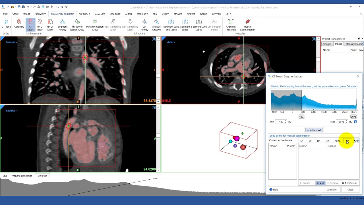 How to Quickly Segment a Heart with the CT Heart Tool | Materialise Mimics Innovation Suite