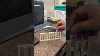 This test reveals your REAL sugar level 😳! #doctor #lablife #science