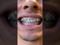 Why I’m removing my braces… 😳