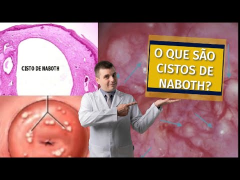 Cisto no Colo do Útero (Cisto de Naboth)